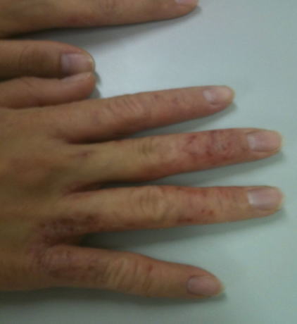 アトピー性皮膚炎（手）