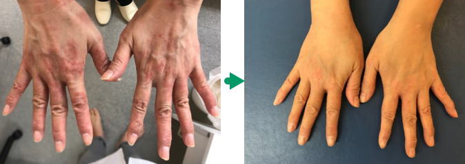 手の湿疹の変化