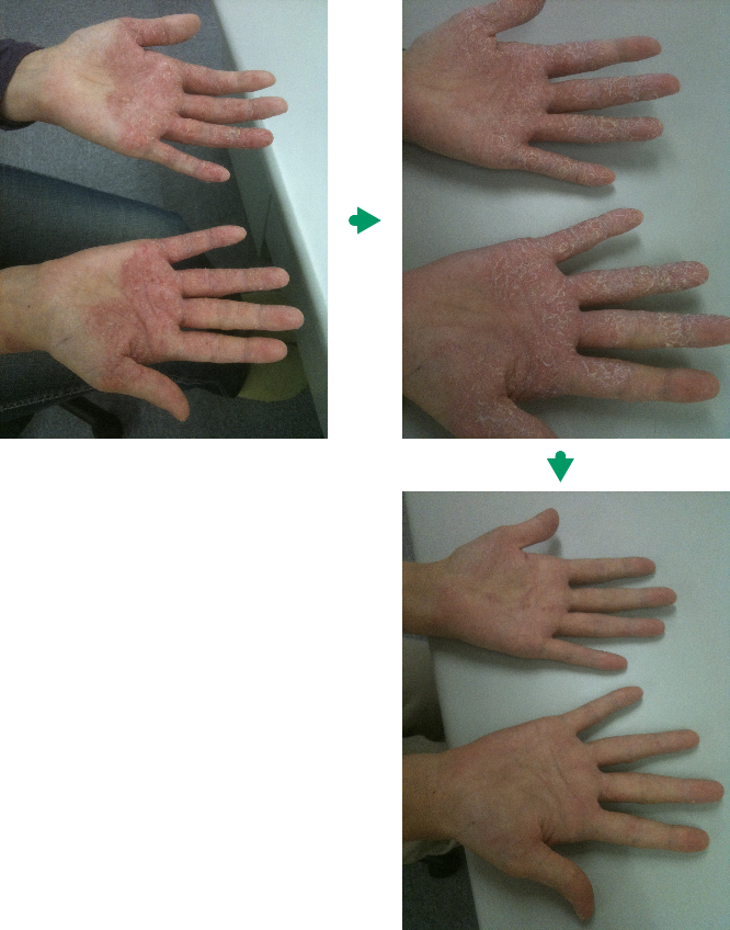 手の湿疹の変化
